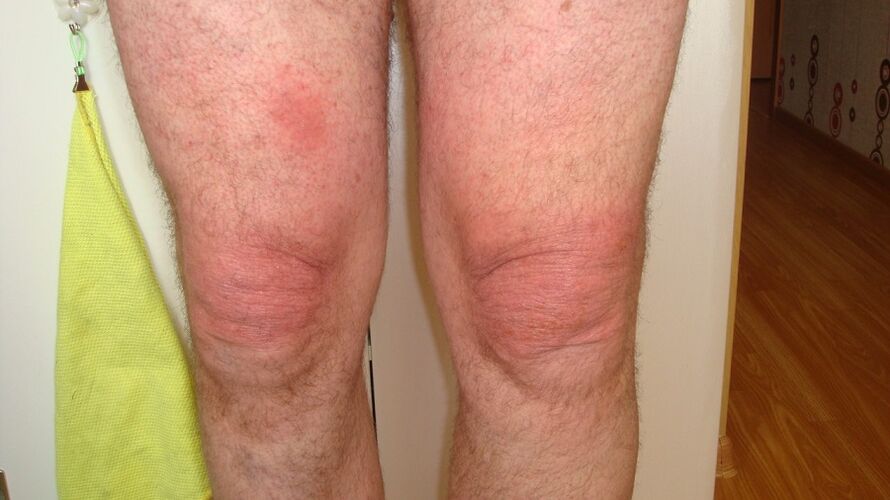 артроза на колянните стави